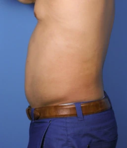 Case--389 | After Body 2