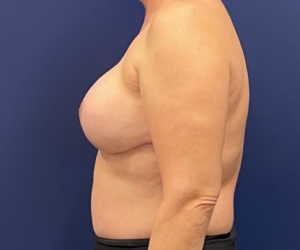 Breast-Reconstruction-Case--308 | After Dr. Samir Rao 2