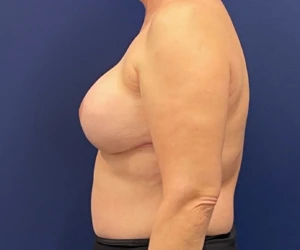 Breast-Reconstruction-Case--308 | After Dr. Samir Rao 2