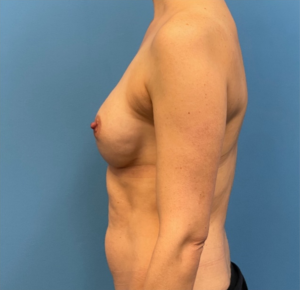 Breast-Reconstruction-Case--25209 | After Dr. Samir Rao 2