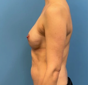 Breast-Reconstruction-Case--25209 | After Breast Reconstruction 2