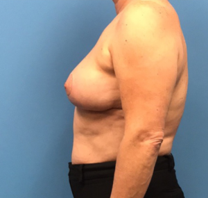 Case--314 | After Dr. Samir Rao 2