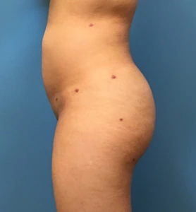 Brazilian-Butt-Lift-Case--73 | After Dr. Samir Rao 2