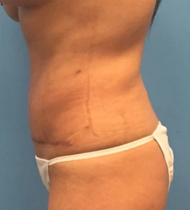 Case--65 | After Body 2