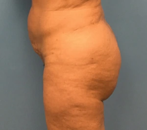 Brazilian-Butt-Lift-Case--74 | After Body 1