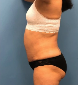 Case--14819 | After Body 2