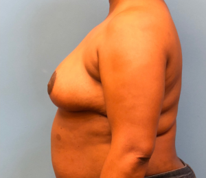 Breast-Reduction-Case--12894 | After Breast Reduction 2