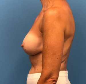 Revision-Augmentation--13287 | After Dr. Samir Rao 2