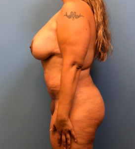 Lipoabdominoplasty-Breast-Augmentation-Case--15133 | After Mommy Makeover 2