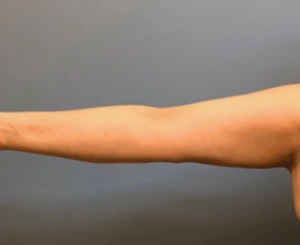 Brachioplasty-Case--78 | After Dr. Samir Rao 1