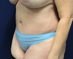Liposuction-Tummy-Tuck-Case--25682-2 | After Liposuction 2