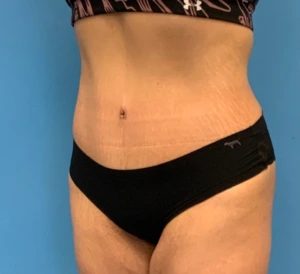 Abdominoplasty-Case--23747 | After Body 2