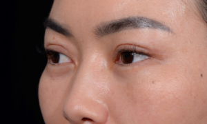 Blepharoplasty-Case--356 | After Eyelid Surgery 2