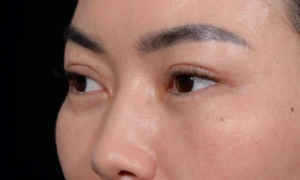 Blepharoplasty-Case--356 | After Face 2