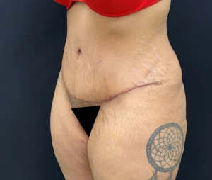 Liposuction-Tummy-Tuck-Case--338 | After Body 2