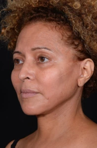 Facelift-Case--360 | After Face 2