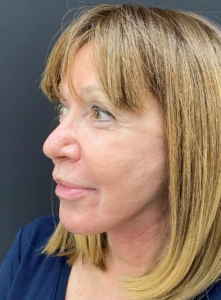 Facelift-Case--365 | After Dr. Arjun Kanuri 2