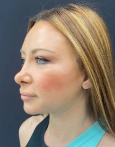 Facelift-Case--355 | After Face 2