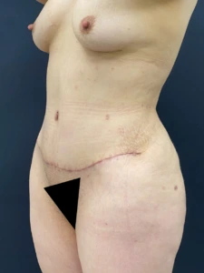Lipoabdominoplasty-Case--339 | After Body 2