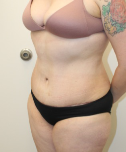 Liposuction-Tummy-Tuck-Case--343 | After Liposuction 2