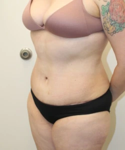 Liposuction-Tummy-Tuck-Case--343 | After Body 2