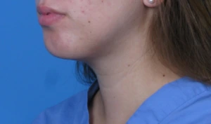 Case--293 | After Face 2