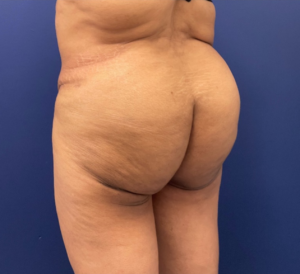 Brazilian-Butt-Lift-Case--215 | After Brazilian Butt Lift 2