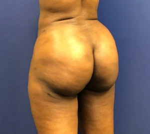 Brazilian-Butt-Lift-Case--267 | After Body 1