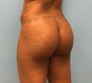 Brazilian-Butt-Lift-Case--271 | After Body 1