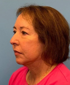 Facelift-Case--21241 | After Face 2