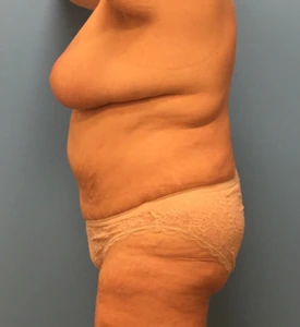 Mommy-Makeover-Case--39 | After Body 2