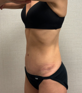 Revision-Tummy-Tuck-Case--23643 | After Tummy Tuck 2