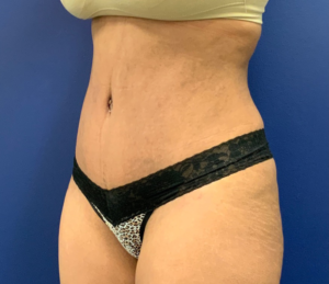 Lipoabdominoplasty-Case--21755 | After Tummy Tuck 2