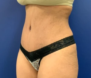 Lipoabdominoplasty-Case--21755 | After Body 2