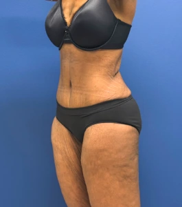 Tummy-Tuck-Case--28714 | After Body 2