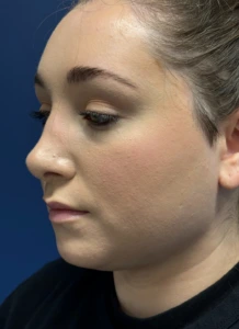 Submental-Liposuction-Case--29107 | After Face 1