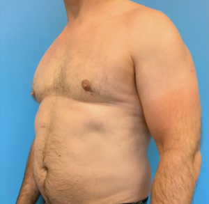 Gynecomastia-Case--20376 | After Gynecomastia / Male Breast Reduction 2