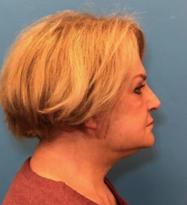 Facelift-Case--14460 | After Face 2