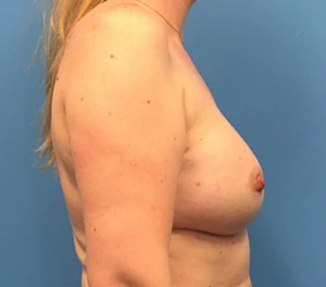 Case--138 | After Breast Reconstruction 2