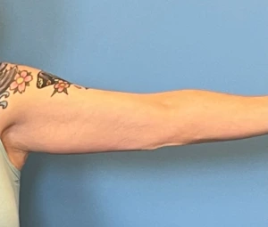 Brachioplasty-Arm-Lift-Case--18182 | After Body 2