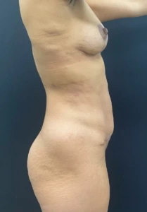 Mommy-Makeover-Case--384 | After Body 2