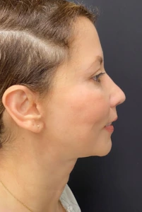 Rhinoplasty-Case--375 | After Face 2