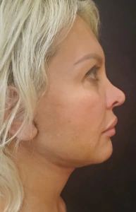 Facelift-Case--362 | After Face 2