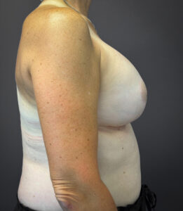Augmentation-Mastopexy-Case--1213 | After Breast Augmentation With Lift 2