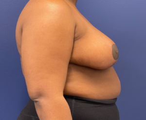 Breast-Reduction-Case--240 | After Breast Reduction 2