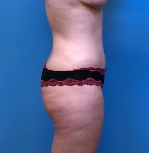 Abdominoplasty-Flank-Liposuction-Case--244 | After Body 2
