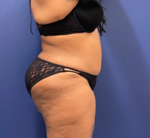 Lipoabdominoplasty-Case--245 | After Dr. Samir Rao 2