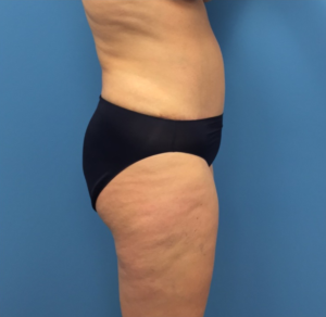 Case--248 | After Liposuction 2