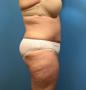 Case--249 | After Body 2