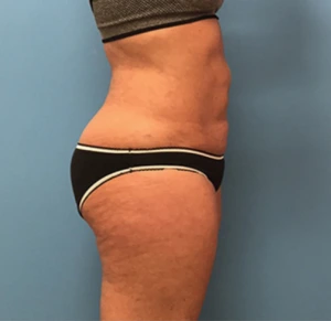 Liposuction-Case--72-1 | After Body 2